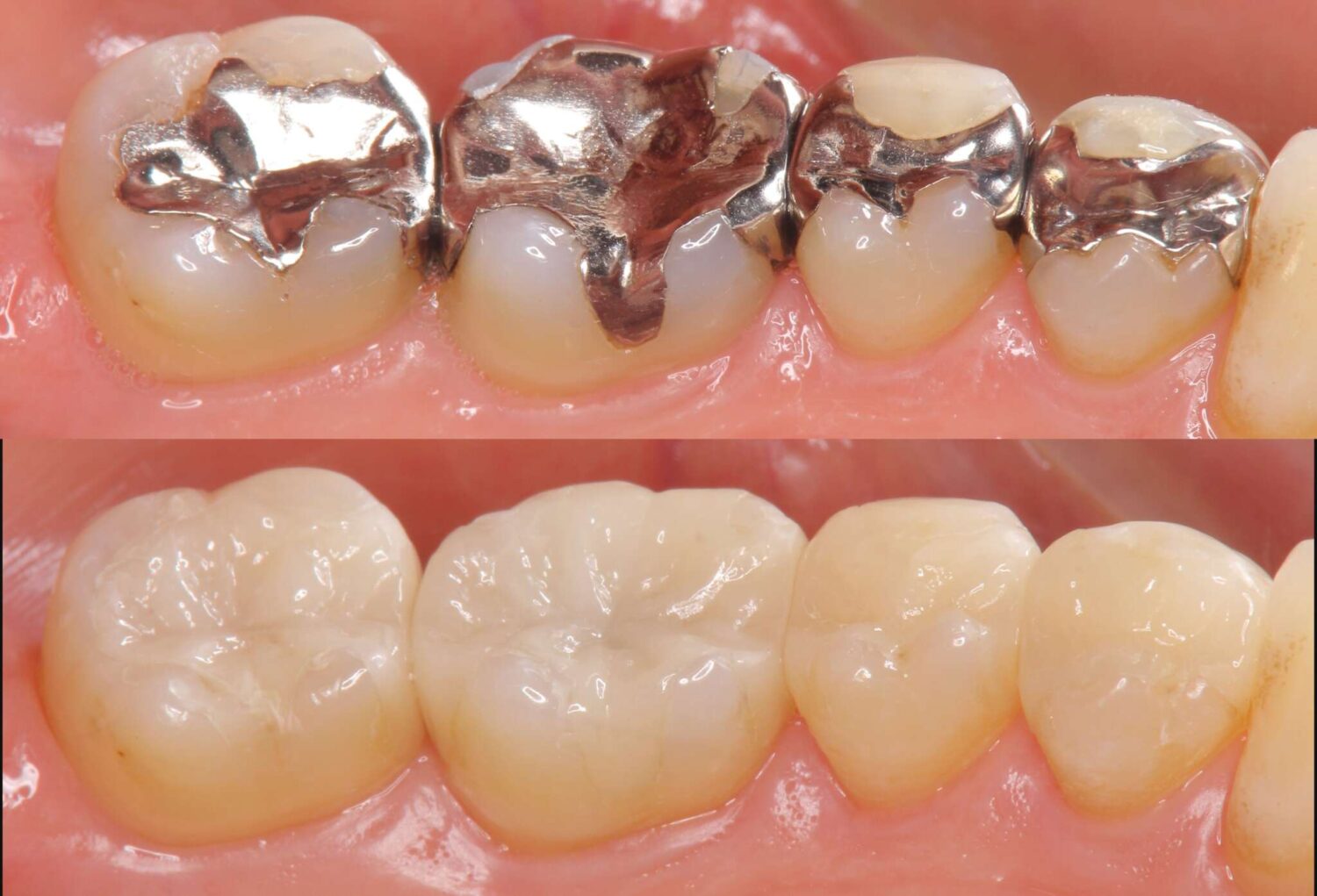 歯科医院での銀歯を白くするセラミック治療