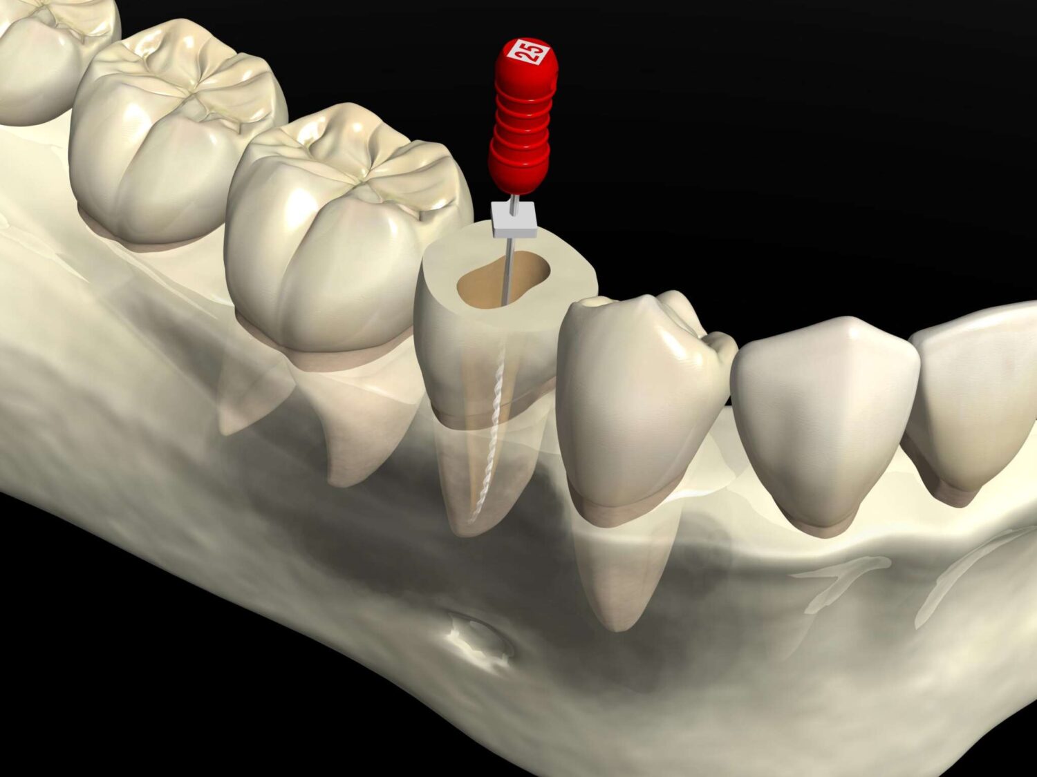歯科医院での根管治療について