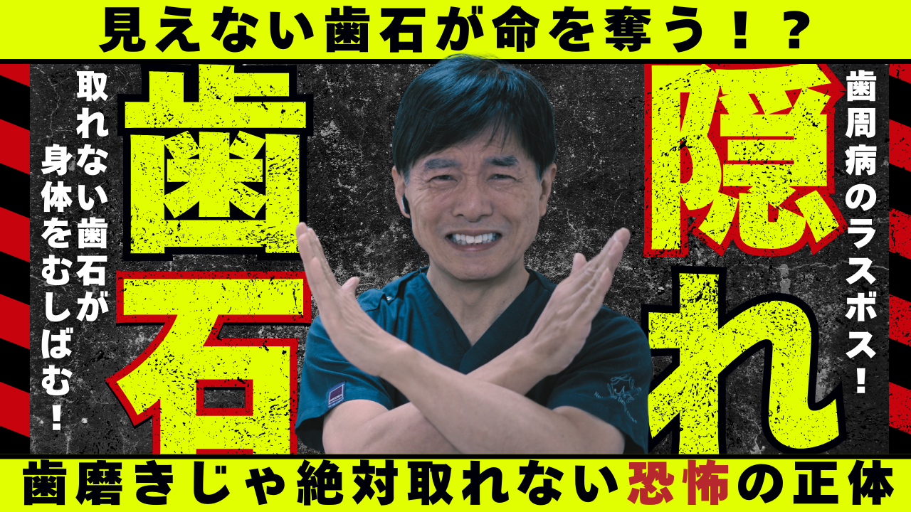 「隠れ歯石」って知っていますか?実はものすごく悪いやつです。