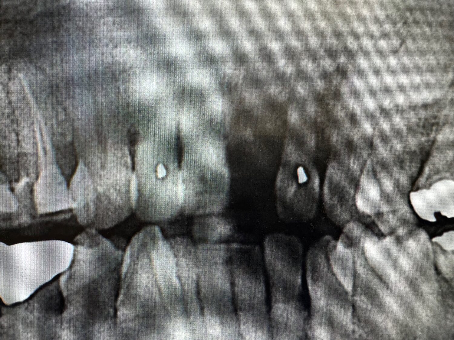 交通事故で前歯を1本失った方へのインプラント手術を行いました
