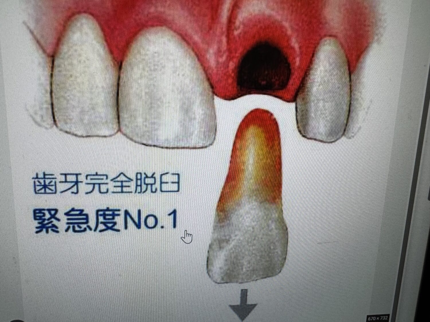 歯が抜けた時はリミットは60分 　「緊急度№1」　直ぐに歯医者に受診
