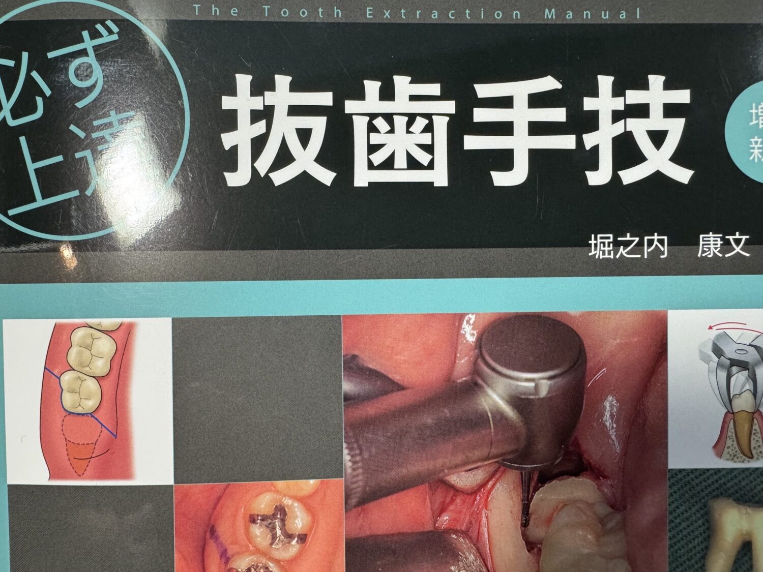 抜歯は「力」ではない！若い歯科医師に伝えたい抜歯の技術