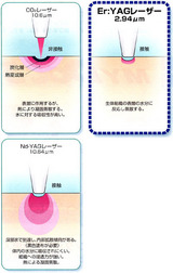 ヒールオゾンの虫歯治療