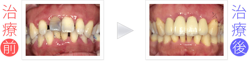 治療症例：前歯4本の歯周病＆矯正＆セラミック治療