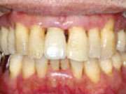 歯のクリーニングに通院された結果
