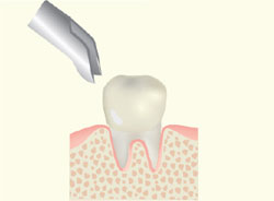虫歯の抜歯