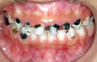 虫歯の進行抑制