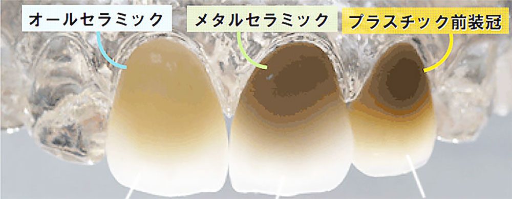 被せ物の比較(オールセラミックなど)