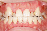 歯周病の進行度（軽度）