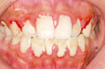 歯周病の進行度（中度）