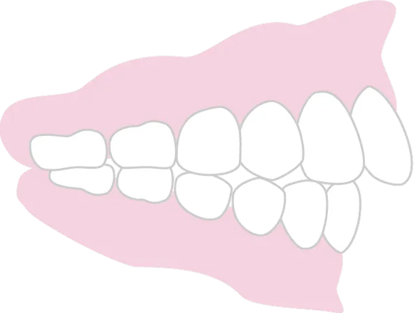 上顎前突「出っ歯」