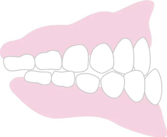 反対咬合「受け口」