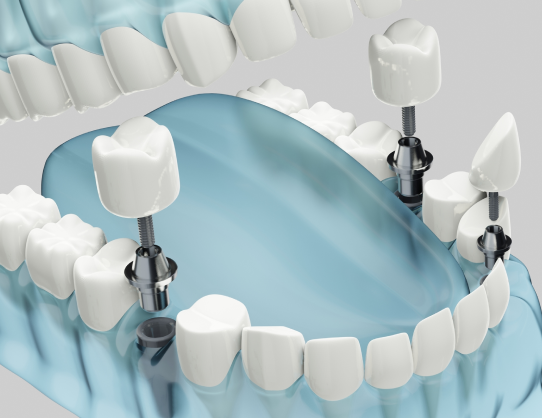 岡山の歯医者 なかの歯科・矯正歯科クリニックではノーベルガイドを導入しています