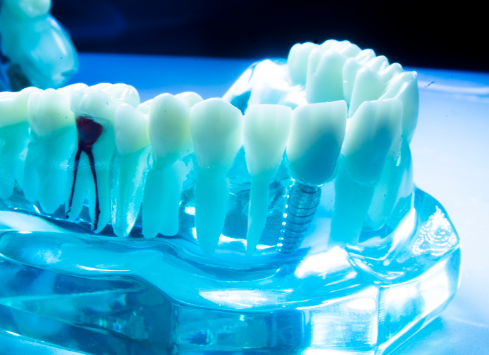 岡山の歯医者「なかの歯科・矯正歯科クリニック」が教えるインプラントのメリット・デメリット