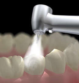 岡山の歯医者「なかの歯科・矯正歯科クリニック」のヒールオゾン治療