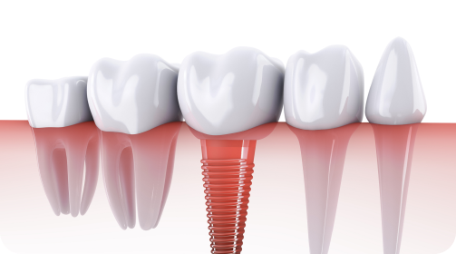 岡山の歯医者 なかの歯科・矯正歯科クリニックのインプラント保証