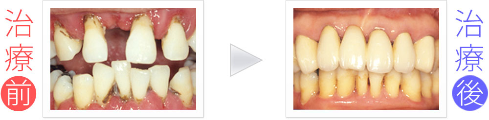 上前歯6本の歯周病＆セラミック治療（30代女性）