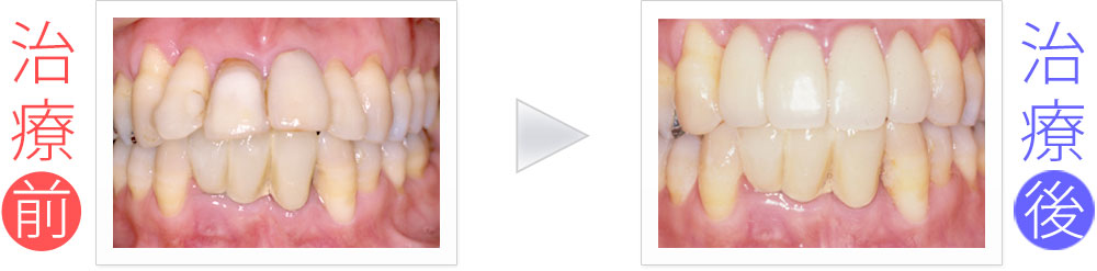 上下前歯7本の歯周病＆セラミック治療（30代女性）