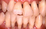 早期発症型歯周炎