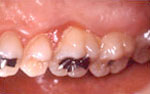 歯性上顎洞炎