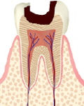 c2（象牙質に進行した虫歯）