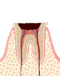 c4（歯の頭の部分が崩壊し、根の部分のみ残った虫歯）