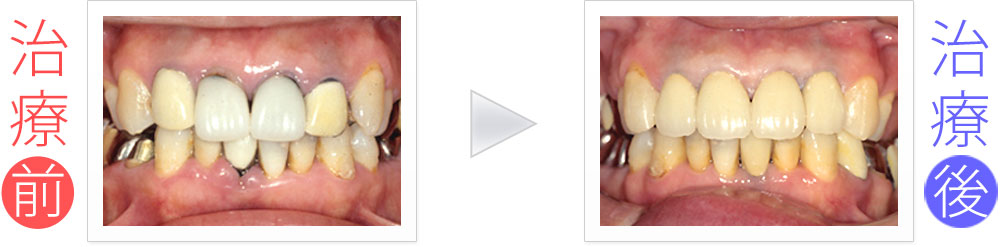 前歯7本の歯周病＆セラミック治療