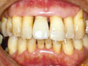 歯周病治療を行った結果、歯茎が引きしまり出っ歯も自然に治りました
