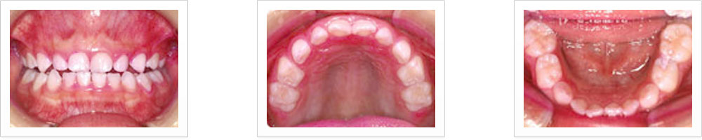奥歯に治療が必要な虫歯があったので白い詰め物し、その後予防歯科