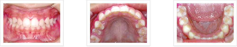 乳歯の時は虫歯が多くあったのですが、定期的な予防歯科診療を受けたことで、小学5年生の今、永久歯が虫歯ゼロ