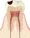 C1（エナメル質に進行した虫歯）