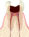 C3（歯の中の神経にまで進行した虫歯）